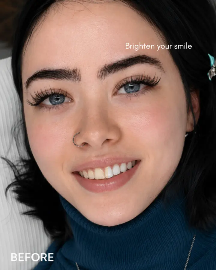 Hermosa Haus teeth whitening result